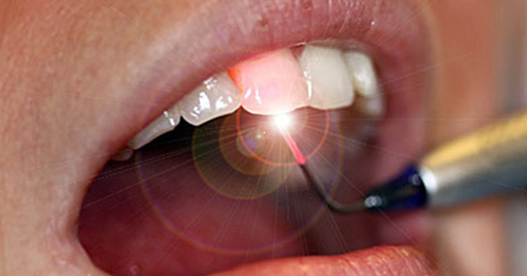 Zahnarzt Idar-Oberstein - Schonende Laserbehandlung